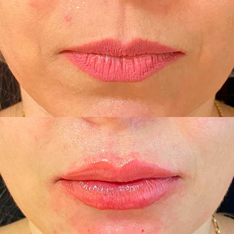 Antes e Depois do preenchimento Labial